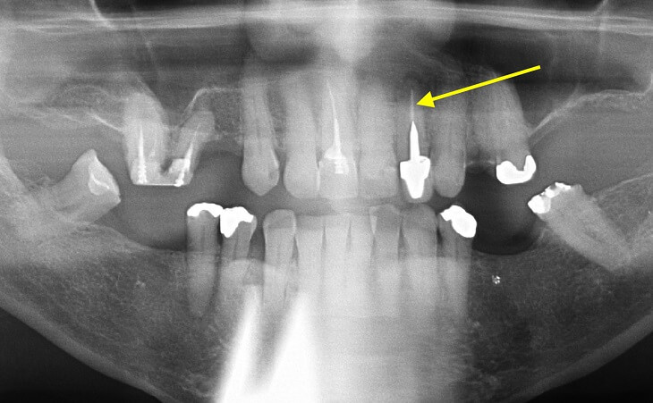 Tooth Before Replacement