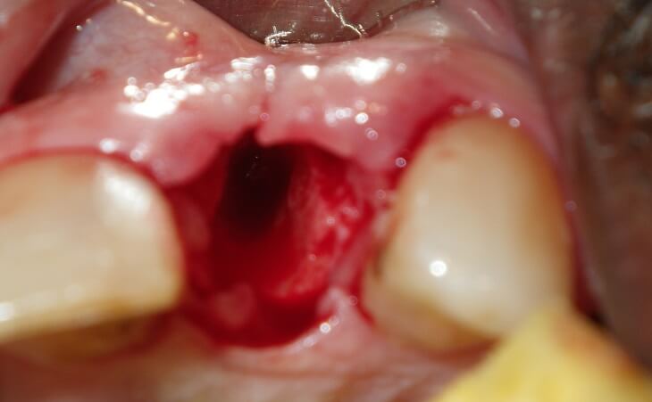 Extraction Of Tooth For Dental Implant