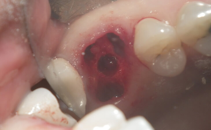 Tooth Extraction For Immediate Dental Implants