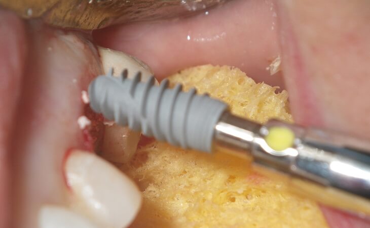 Placing Dental Implant