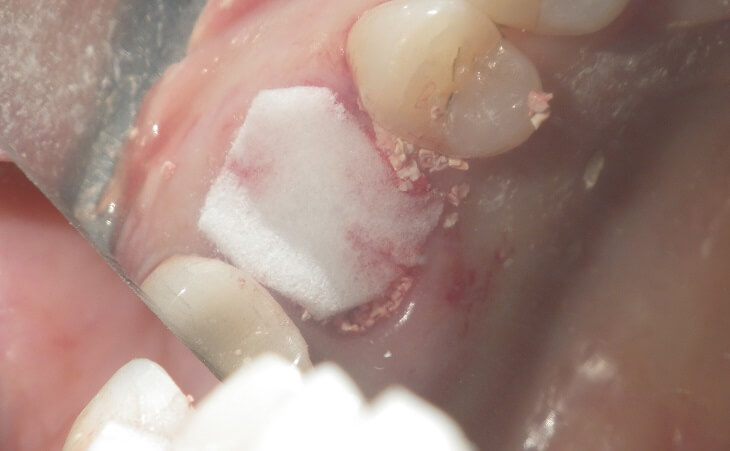 Dental Implant Bone Regeneration