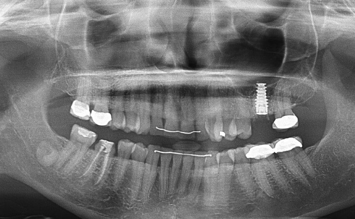 Dental Implant In Place