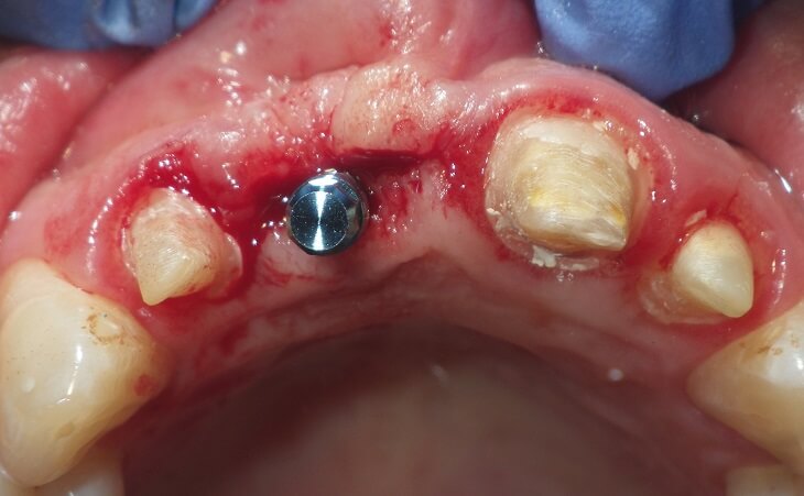 Dental Implant For Missing Front Tooth