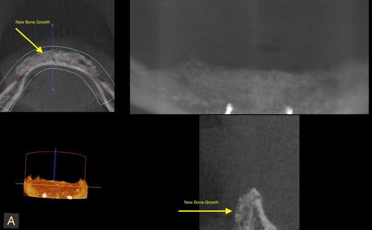 Bone Growth From Bone Regeneration