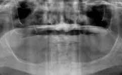 Bone Lost And Unstable Denture Treatment X-Ray