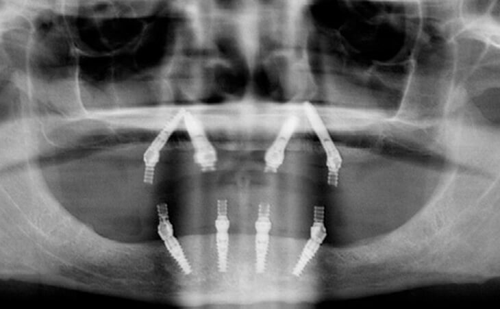 Bone Lost And Unstable Denture Treatment X-Ray Scan