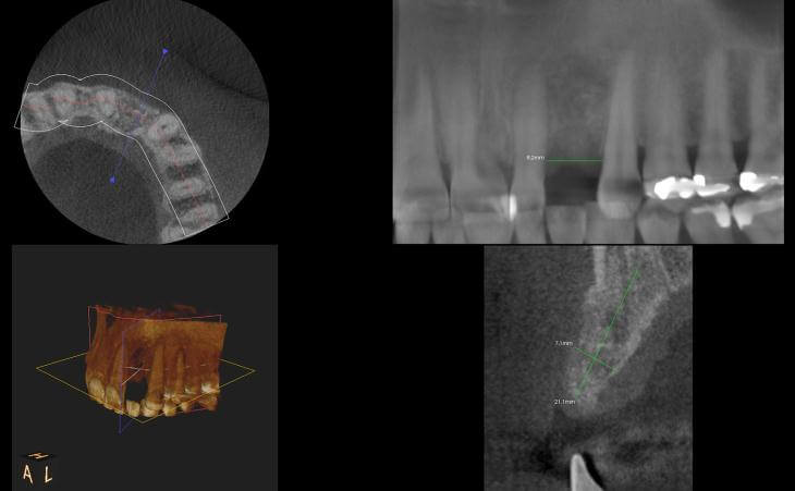 Bone Defect & Missing Tooth Treatment CT Scan