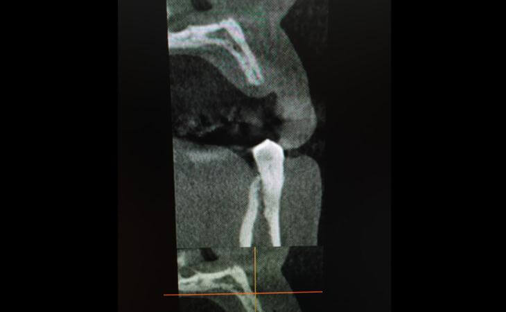 Resorbed Ridge X-Ray