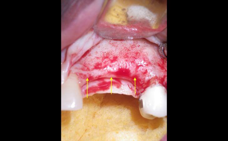 Thin Ridge Treatment