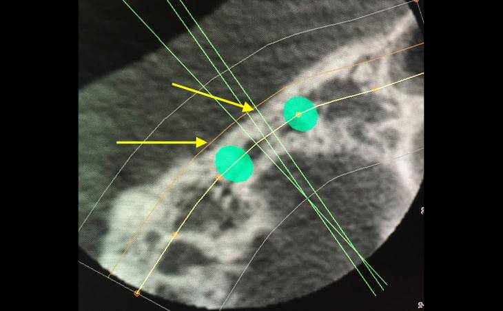 Resorbed Ridge CT Scan