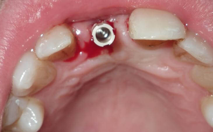 Temporary Abutment For Single Dental Implant