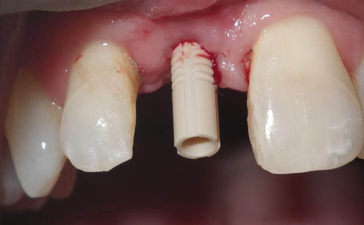 Temporary Connector For Dental Implant