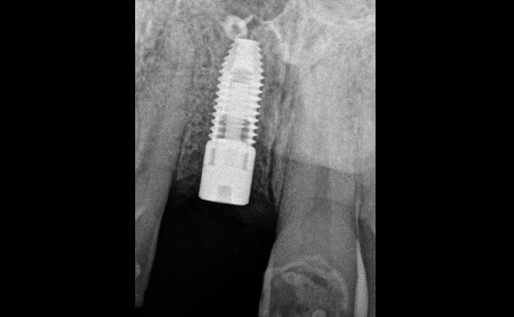 Single Dental Implant X-Ray Scan