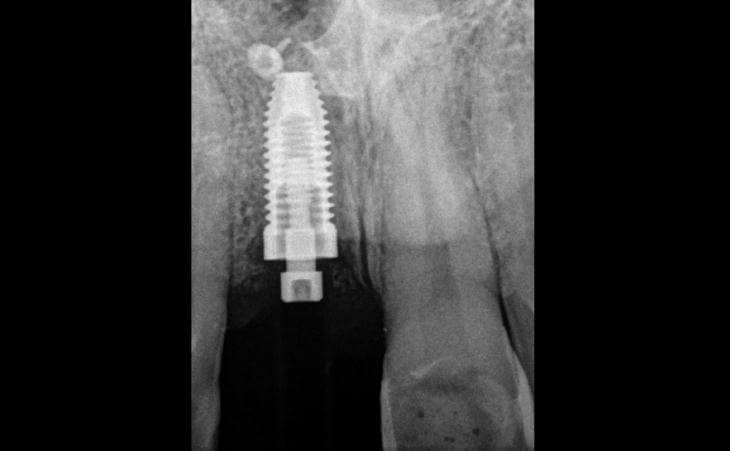 X-Ray Of Single Dental Implant