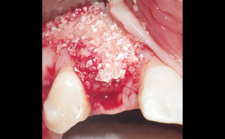 Bone Graft For Missing Teeth Replacement