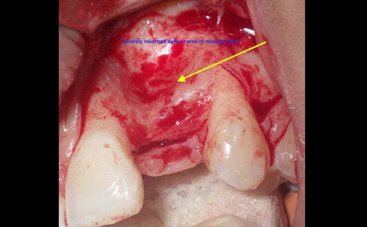 Edentulous Ridge Opened