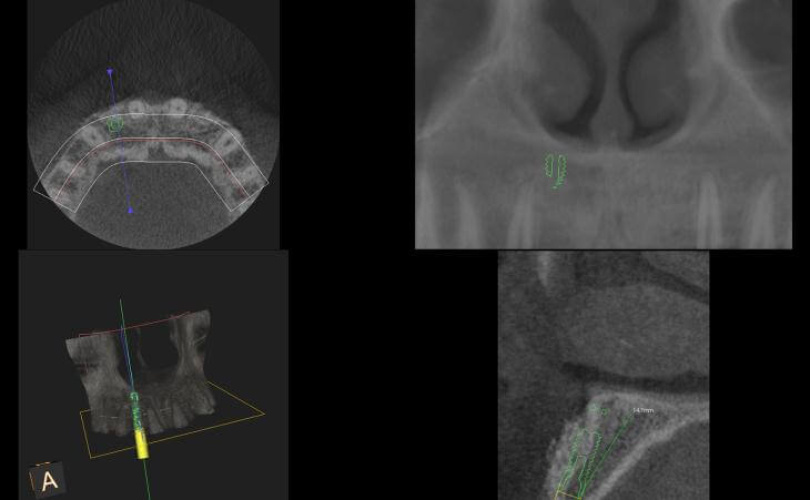 Implant Planning CT Scan
