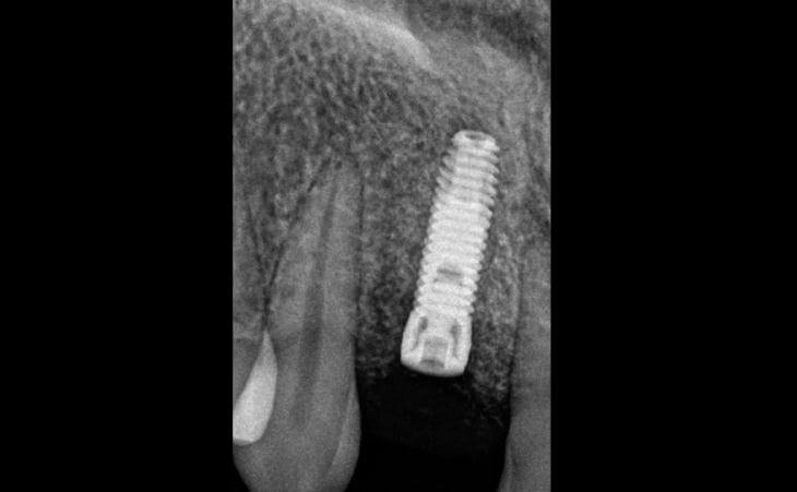 X-Ray Of Dental Implant