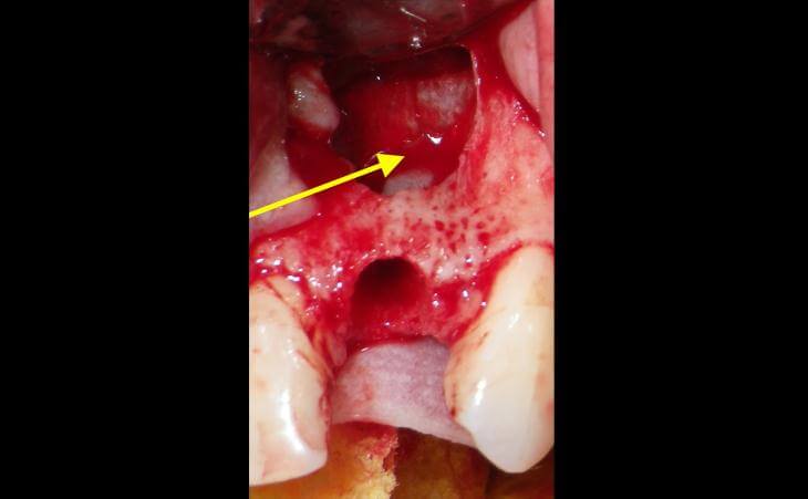Cyst And Tooth Removal