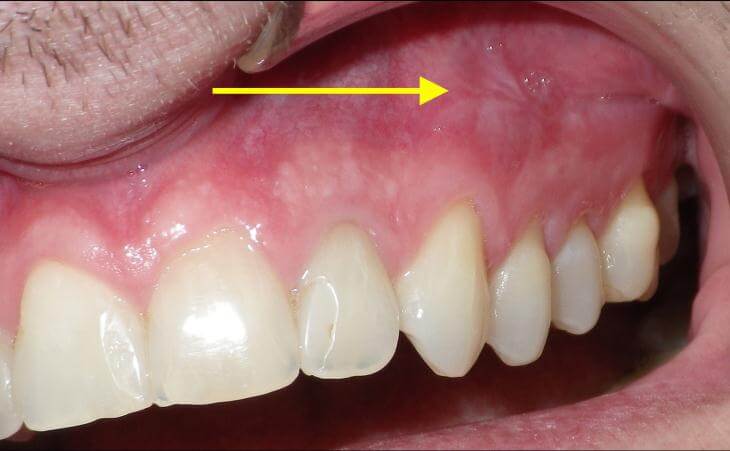 Side Effects Of Oral Cyst