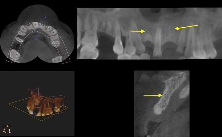 Areas Of Bone Loss