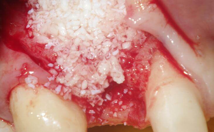 Dental Bone Graft