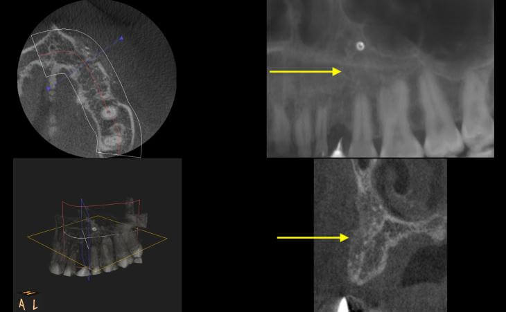 Bone Regeneration Results