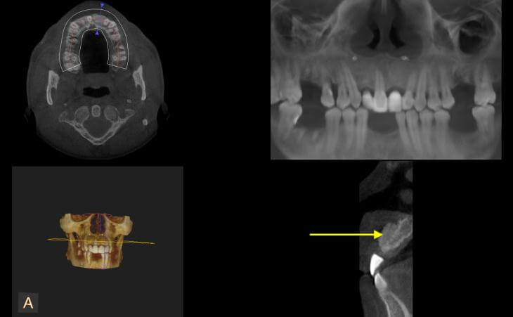 Post-Bone Graft CT Scan
