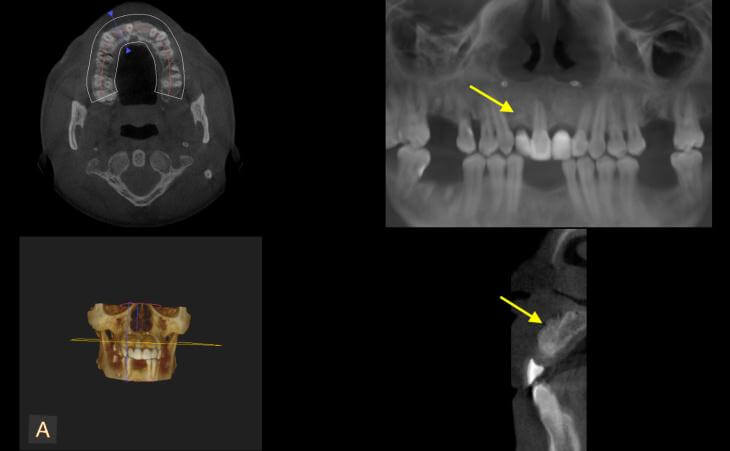 Post-Bone Graft CAT Scan