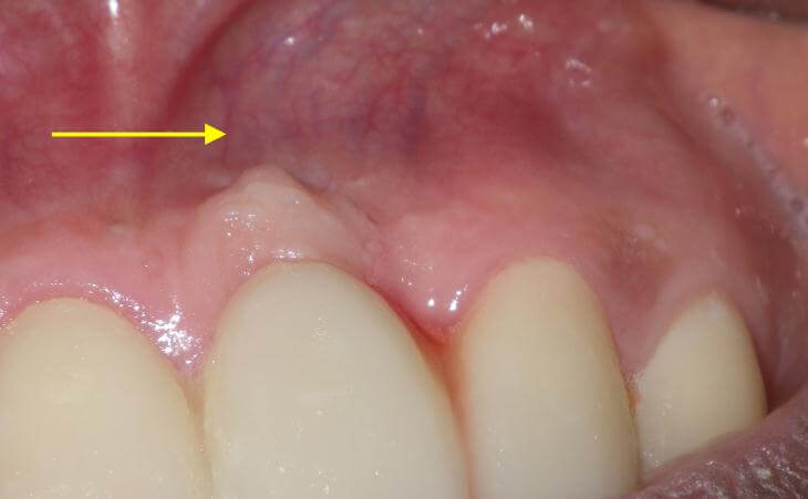 Bone Deficiency Before