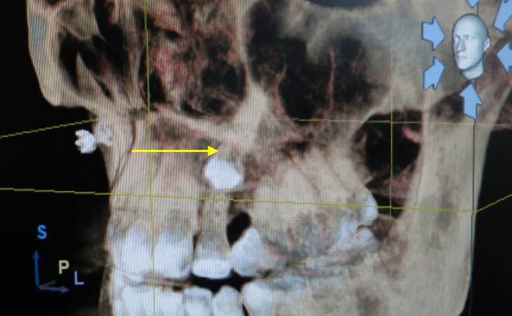 Impacted Tooth Treatment