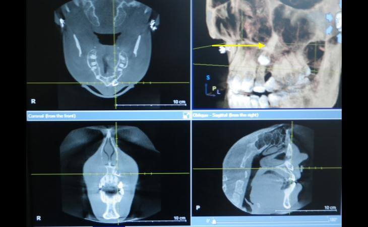 CT Scan Of Impacted Tooth