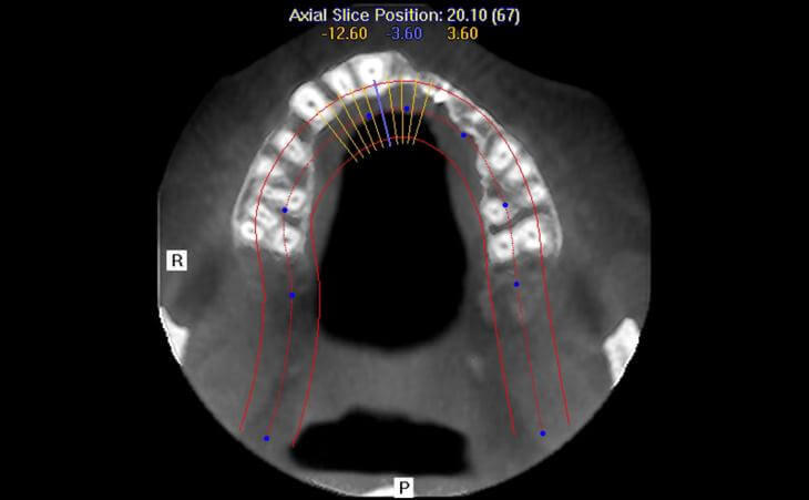 CT Scan Of Thin Upper Jaw Bone