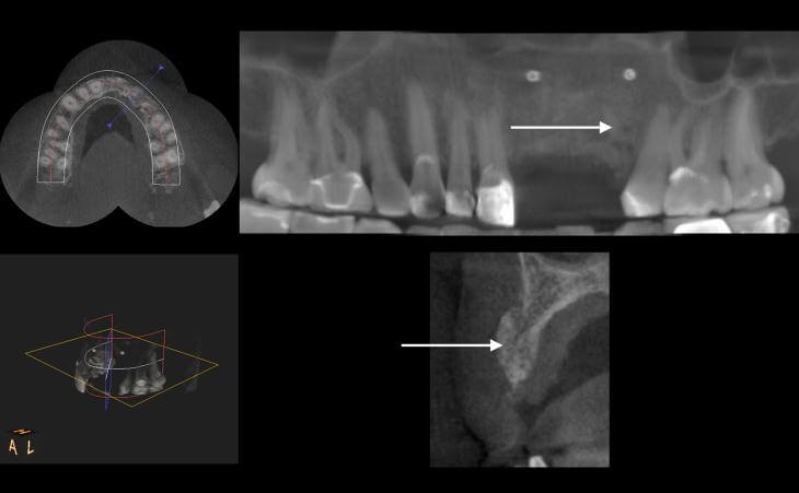 Post-Bone Graft Scan