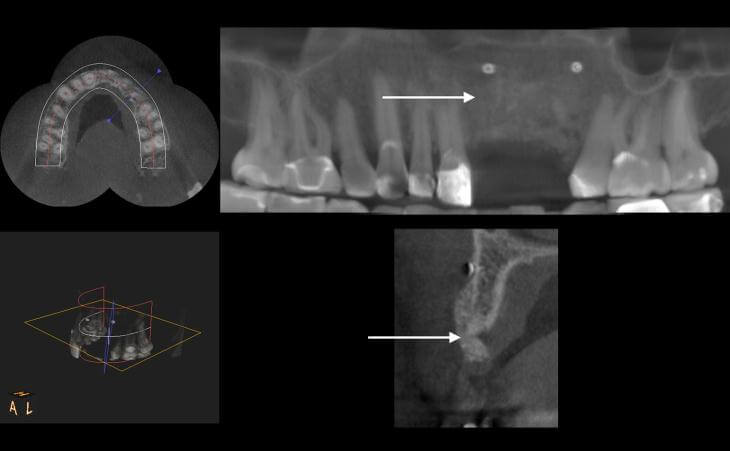 Post-Bone Graft Results