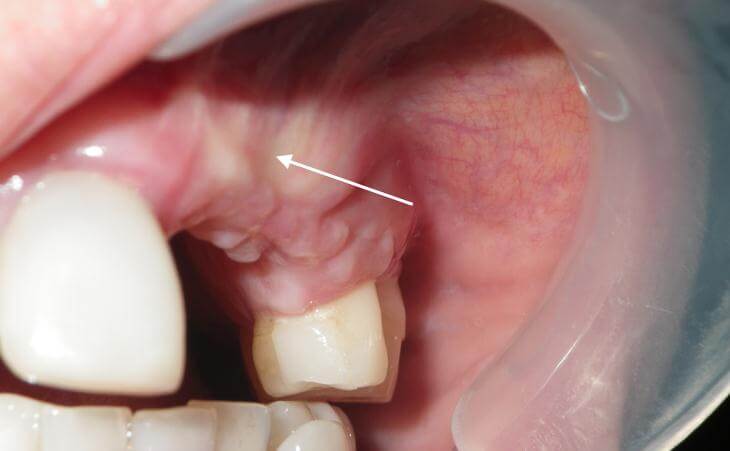 Dental Ridge Bone Graft Before And After