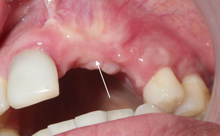 Bone Regeneration Of Jaw Results