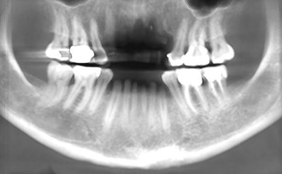 Pre-Bone Graft X-Ray