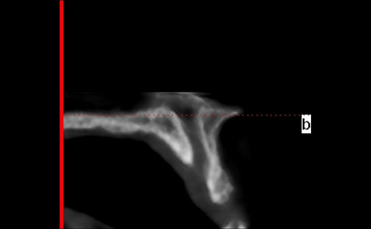 Ct Scan Of Thin Bone Ridge