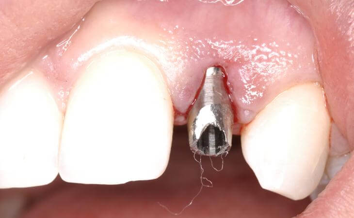 Abutment Placement During Dental Implant Surgery