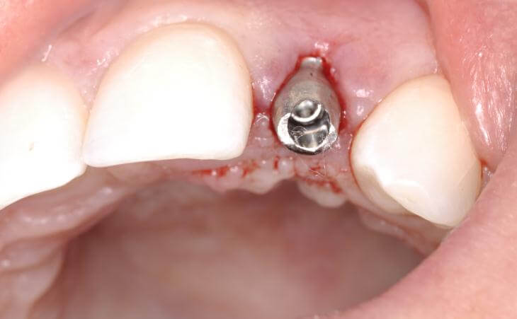 Temporary Dental Abutment