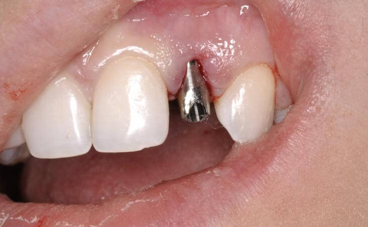 Placement Of Dental Abutment