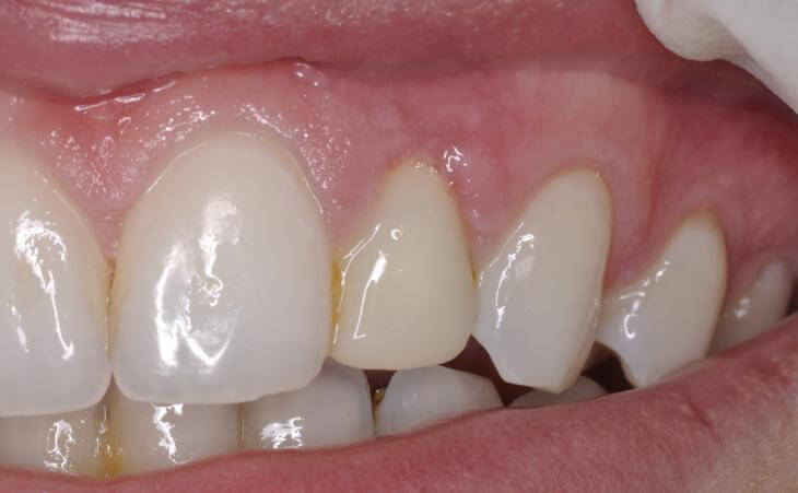 Temporary Tooth For Same Day Dental Implants