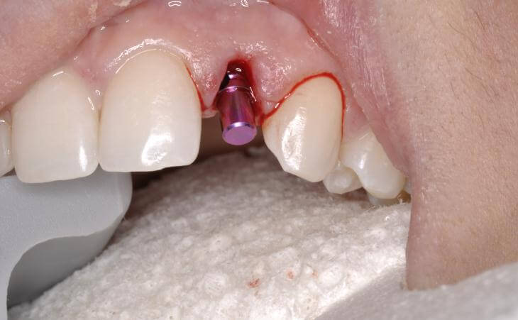 Guided Dental Implant Placement