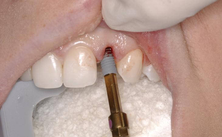 Placement Of Immediate Dental Implant