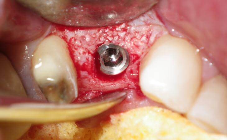 Dental Implants After Bone Graft