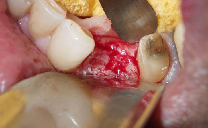 Bone Graft For Dental Surgery
