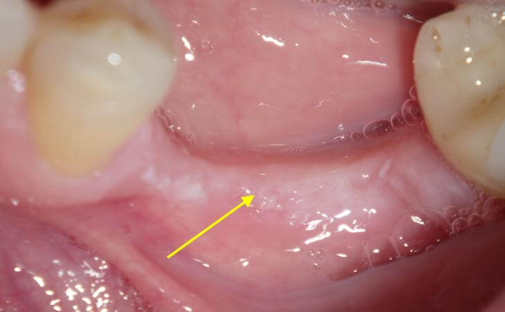 Thin Ridge From Missing Teeth Treatment