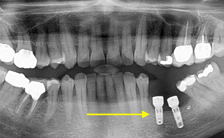 Dental Implants After Bone Regeneration
