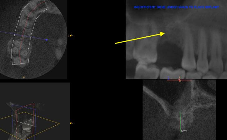 Before Internal Sinus Lift